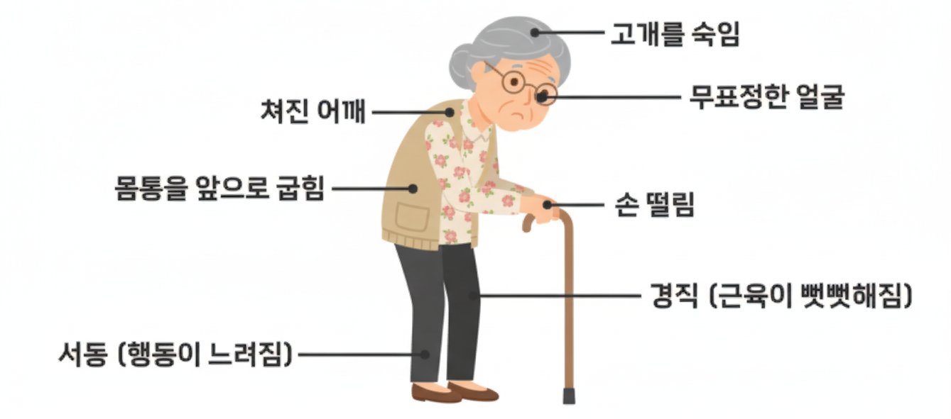 파킨슨병 주요증상 - 고개를 숙임, 처진 어깨, 무표정한 얼굴, 몸통을 앞으로 굽힘, 손 떨림, 경직, 서동